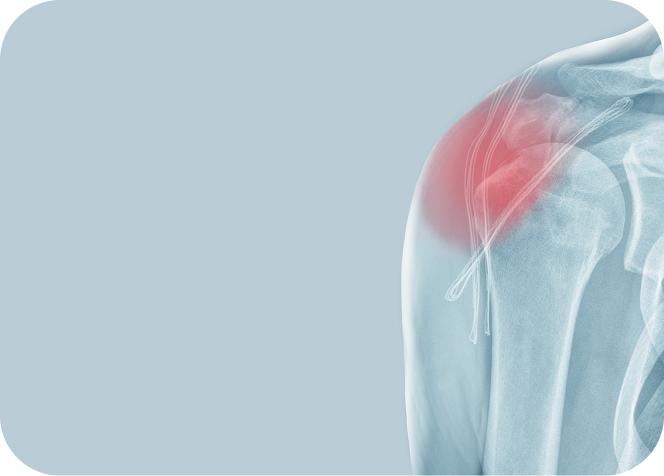 Understanding the latest surgical techniques in shoulder reconstruction